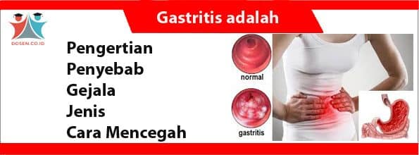 Gastritis adalah